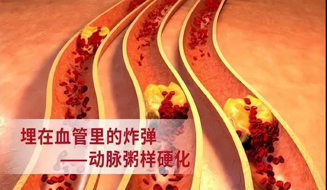 动脉粥样硬化2.jpg