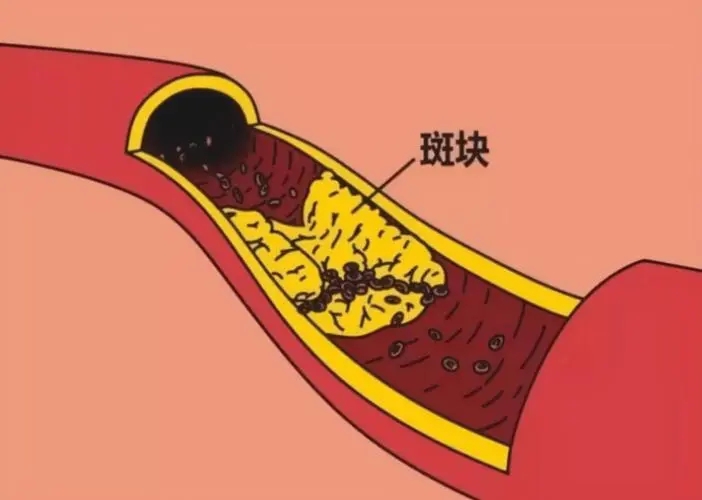 颈动脉斑块.webp.jpg