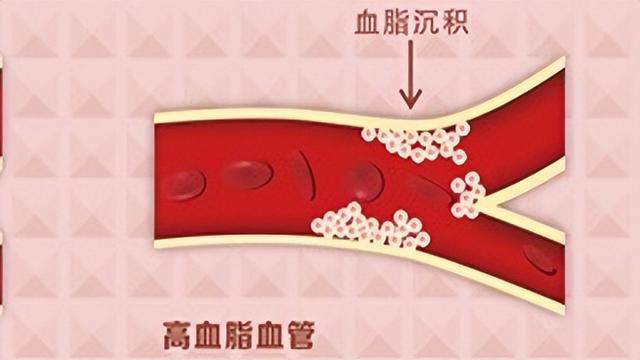 动脉硬化斑块.jpg