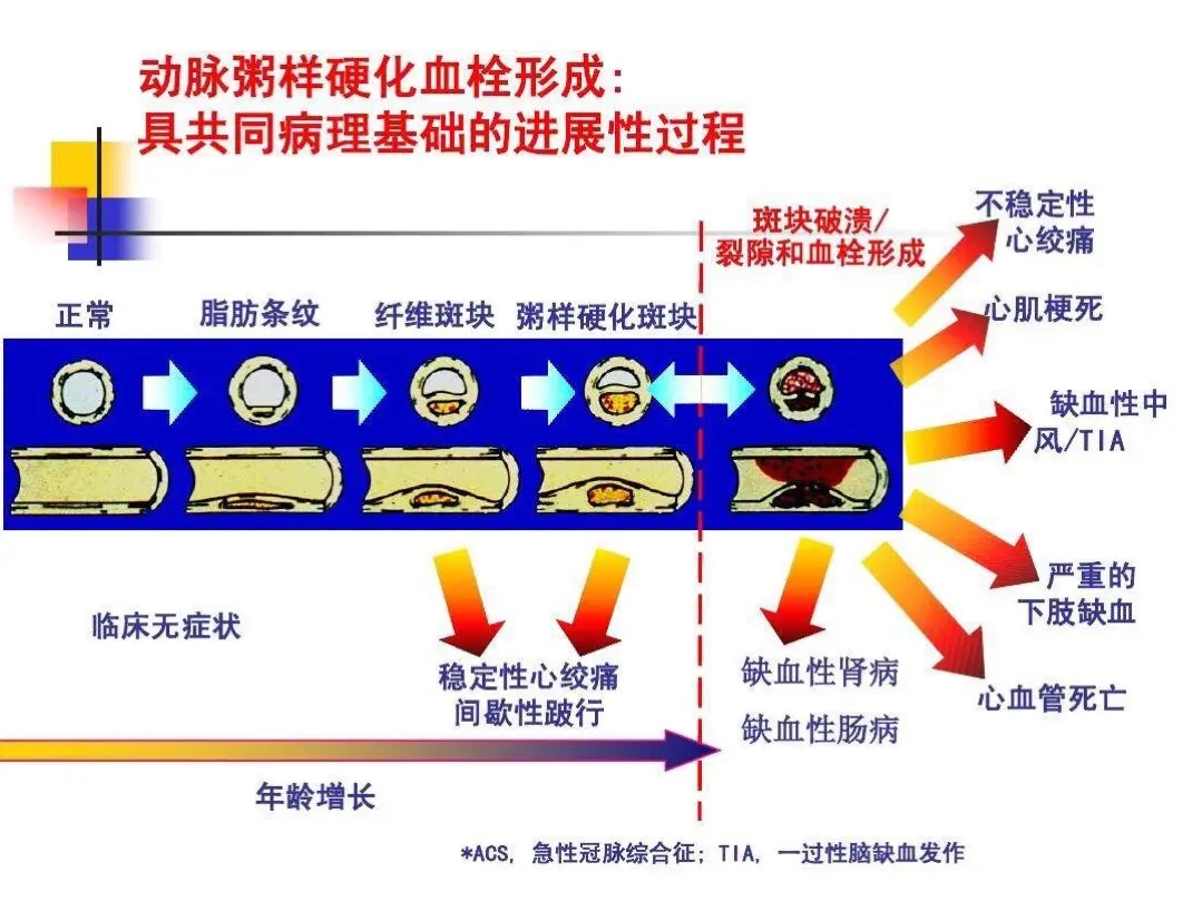 动脉粥样硬化.jpg